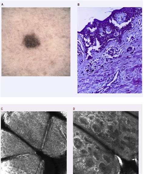 A Dermatoscopy Of A Pigmented Lesion In A Patient With A History Of