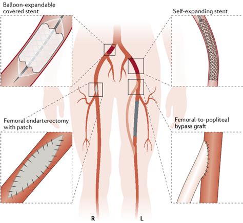 Peripheral Artery Disease Smarty Pance