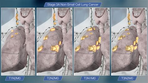 Or, the lung cancer has spread to other parts of the body, such as the brain, bones, liver, or adrenal glands. Stage 3 Lung Cancer : All that you need to know ...