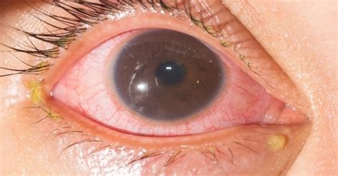 Tiene tratamiento, pero si no se le trata a tiempo, puede volverse una enfermedad crónica. Sífilis ocular: cómo se genera y que síntomas tiene esta ...