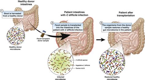 Fecal Transplant Principle Procedure Uses Microbe Online