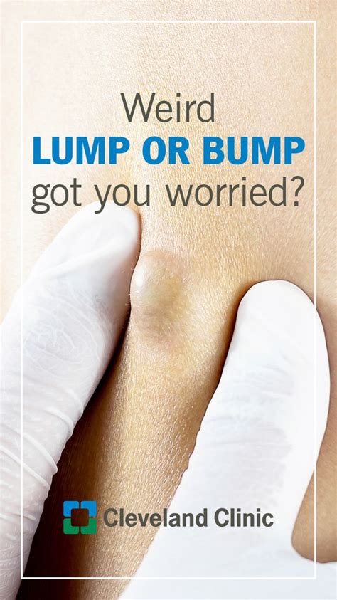 Lumps And Bumps On Your Body When You Should Worry Skin Bumps Neck