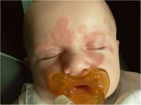 1 Newborn With Erythematous Eruption With Annular Patches And Central