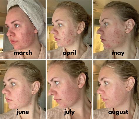 Banda Hormonal Acne 6 Month Progress Spironolactone Aczone Retin