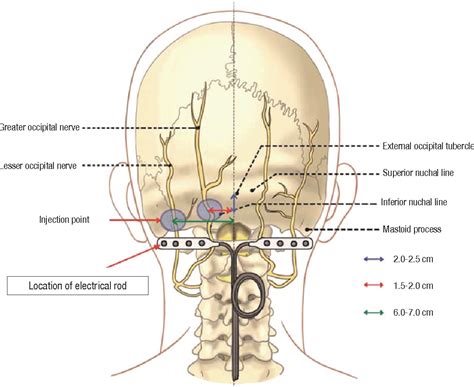 Figure From Neuralgias Of The Head Occipital Neuralgia Semantic