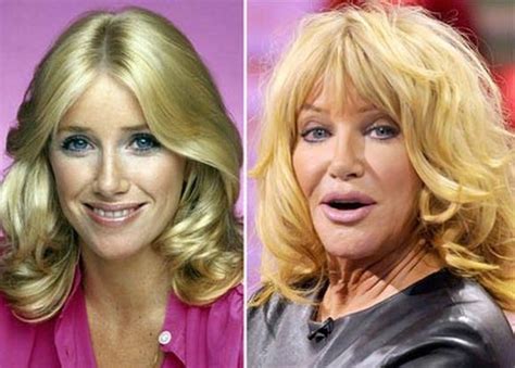 Reviews And Facts Of Suzanne Somers Plastic Surgery