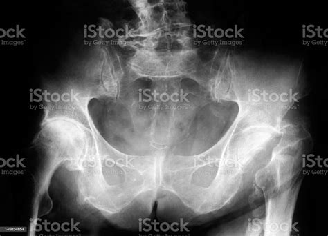 Xray Of Pelvis Stock Photo Download Image Now Forensic Science