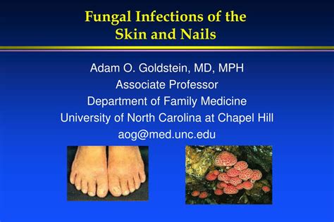 Ppt Fungal Infections Of The Skin And Nails Powerpoint Presentation