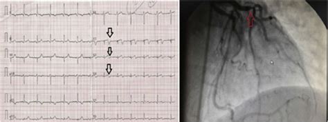Type B Wellens Syndrome Biphasic T Waves On Ecg And Critical Stenosis