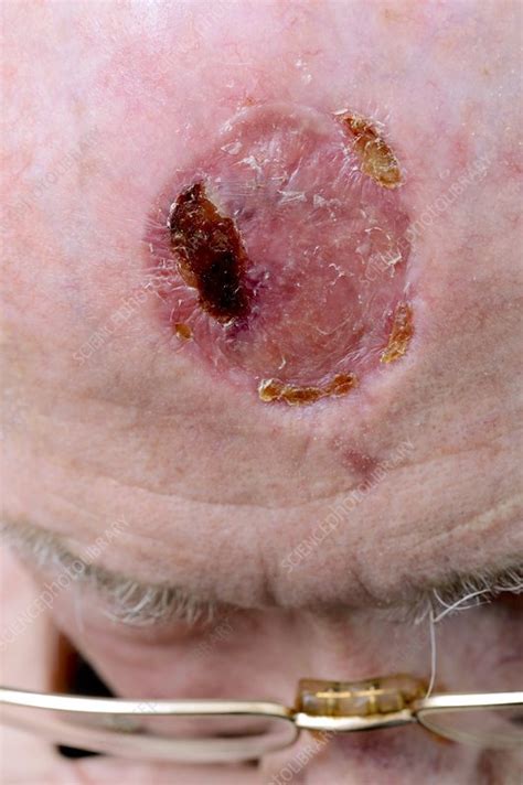 Cancer Skin Graft On The Forehead Stock Image C0156118 Science