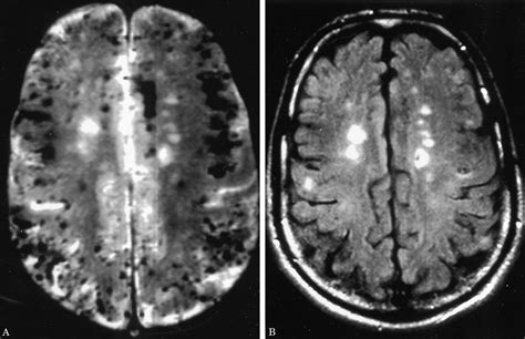 Microhemorrhages On Gradient Echo Mri Neurology