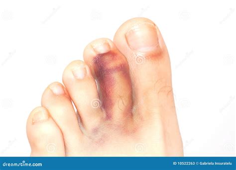 Broken Toe Stock Image Image Of Isolated Human Foot 10522263