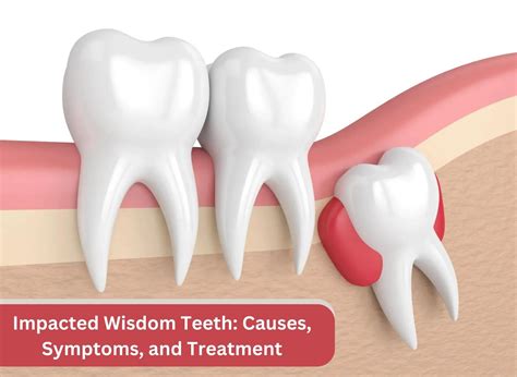 impacted wisdom teeth causes symptoms and treatment
