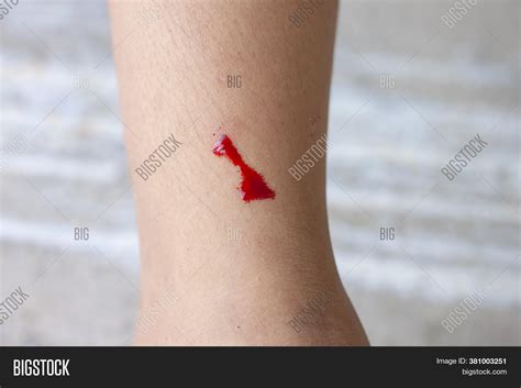 Wounds On Leg Child Image And Photo Free Trial Bigstock