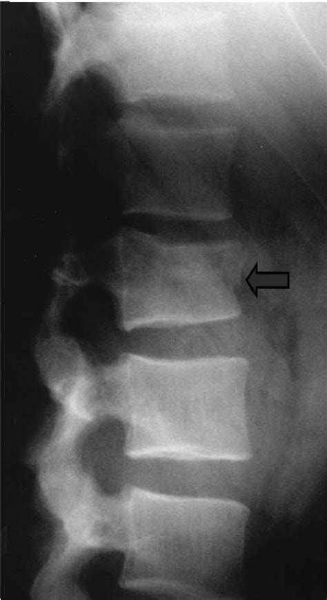 Lateral Spine X Ray Demonstrating A Compression Fracture Download