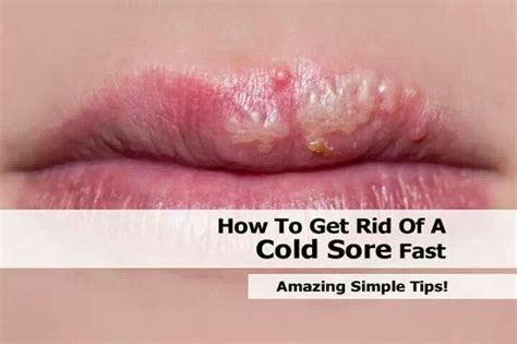 Pin By Wanda Skelton On Home Remedies And Health Cold Sore Canker Sore