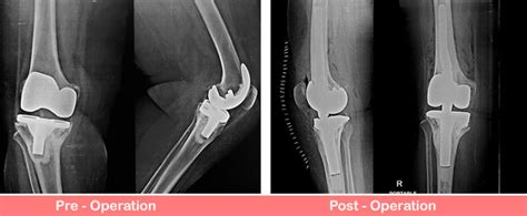 Revision Total Right Knee Replacement Sant Parmanand Hosptal