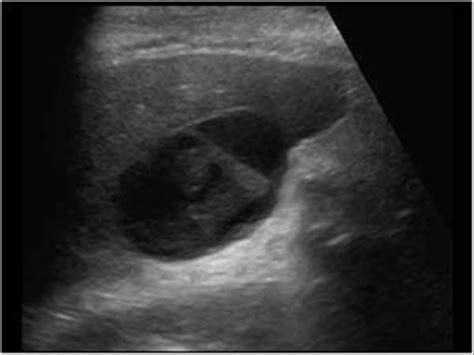 Abdomen And Retroperitoneum 12 Gallbladder And Bile Ducts Case 12