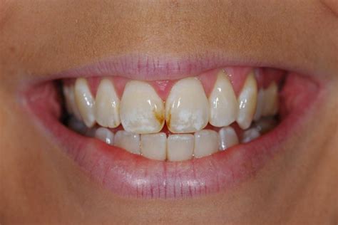 Stains Between Teeth How To Get Rid Of Black Spots Between Teeth MISHKANET COM How Do You