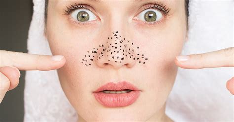 Blackhead Removal How To Get Rid Of Blackheads Easily