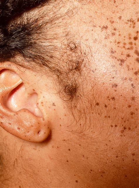 We Have Questions About This Ear Blackhead Removal Video