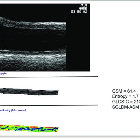 A Demonstrates The B Mode Grayscale Image Of The Distal Common Carotid