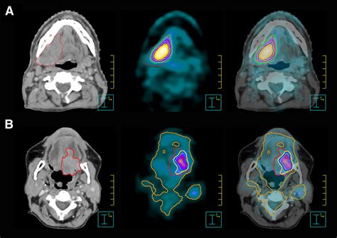 Innovations In Radiotherapy Planning Of Head And Neck Cancers Role Of