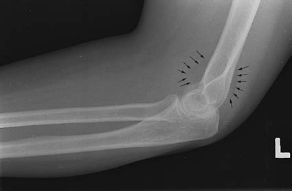 Imaging of the Elbow - TeachMe Orthopedics