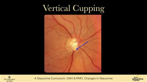 Photos Of Glaucoma Optic Nerve Cupping