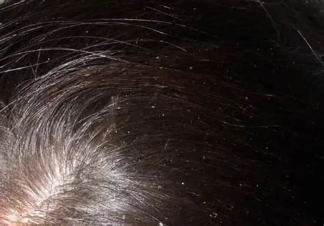 Dandruff In A Child Possible Causes And Features Of Treatment