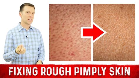 What Does Rough Pimply Skin Chicken Skin Or Keratosis Pilaris Mean