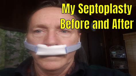 Septoplasty Before And After My Story And Video