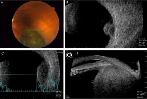 Echographic Features Of Choroidal Melanoma A Melanotic Choroidal