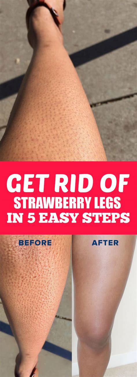 Get Rid Of Strawberry Legs In Easy Steps