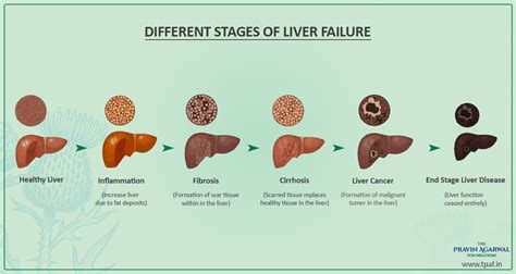Figure From Chronic Liver Disease Staging Classification Based On My