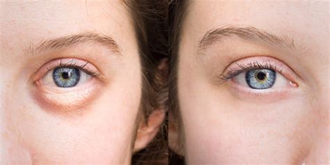 7 reasons you have puffy eyes and how to fix them askmeblogger