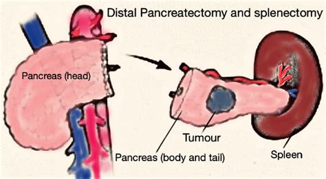Pancreatectomy Pancreatic Resection Surgery Pancreatic Cancer Resection