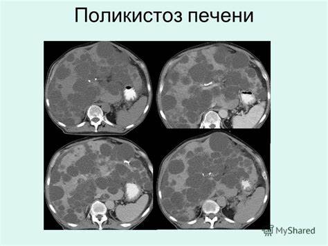 Поликистоз яичник диета Поликистоз печени: причины и лечение, лекарства и диета Поликистоз печени: причины и лечение, лекарства и диета Поликистоз яичник диета