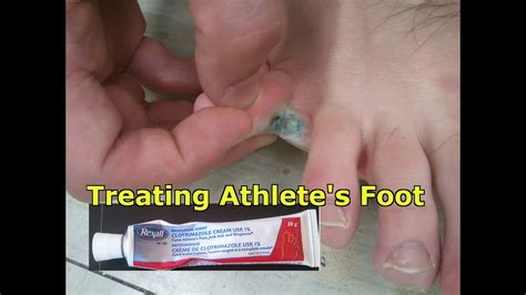 👣 Athletes Foot What Is It How To Treat It And How To Avoid It Youtube