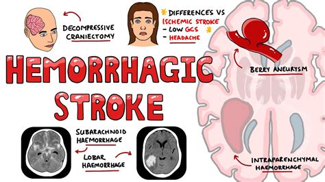 Hemorrhagic Stroke Intracerebral Hemorrhage And Subarachnoid Hemorrhage Management Youtube
