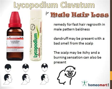 Lycopodium For Hair Loss In Males Homeopathy Medicine Homeopathy