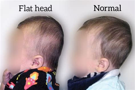 5 Ways To Manage Plagiocephaly Flat Head Syndrome Askdoctorkt