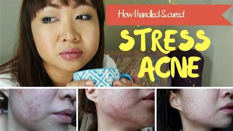 How To Cure Stress Acne Youtube