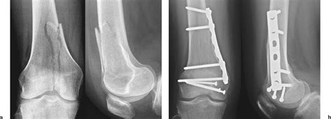 Start studying distal femur fracture. Distal Femur Fractures | Musculoskeletal Key