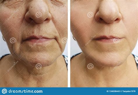 Elderly Woman Wrinkles Face Before And After Health Treatment