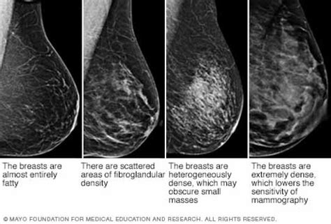 Dense Breast Tissue Troubles With Mammograms And Breast Cancer Kera News