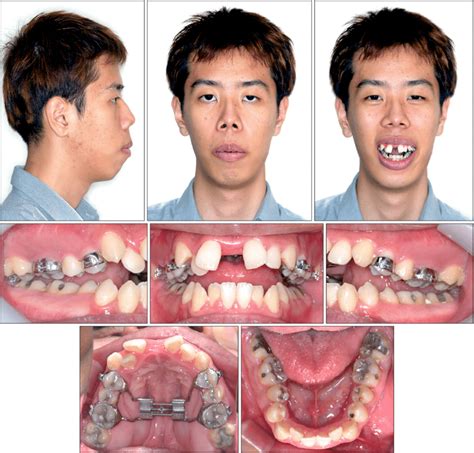 Photographs After 28 Day Expansion Of The Maxilla And Mandible