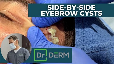 Side By Side Eyebrow Cysts Dr Derm Youtube