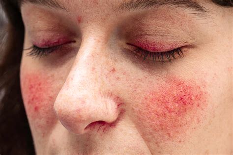 Persistent Red Rash On Cheeks Doctor Explains Scary Symptoms The Best Porn Website