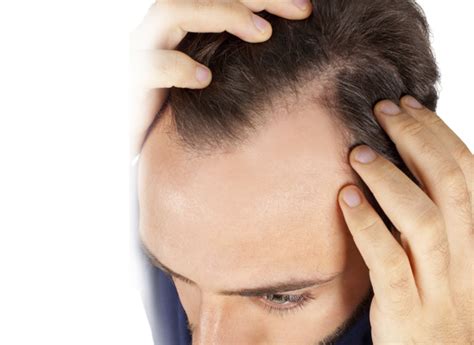 Hair Loss Clinic Manchester Hair Loss Treatment Halo Hair Loss